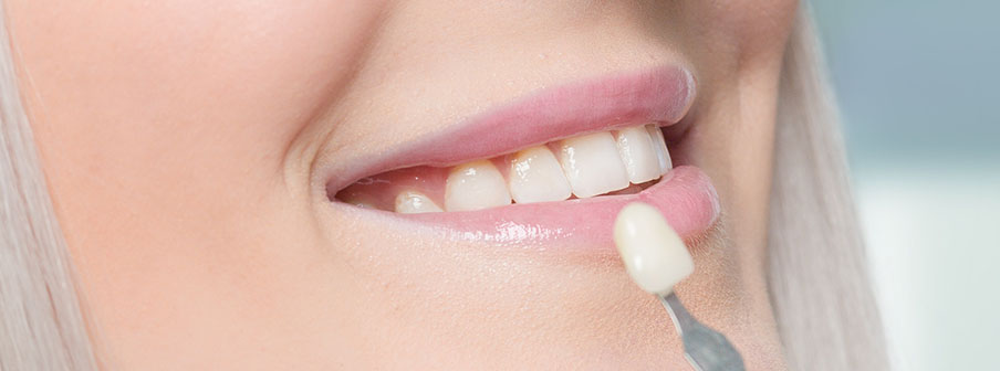 Dental veneers in Las Cruces, NM are an ideal choice.