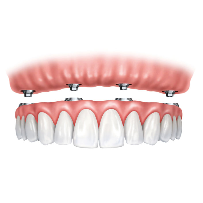 Dental Implant-Supported Dentures